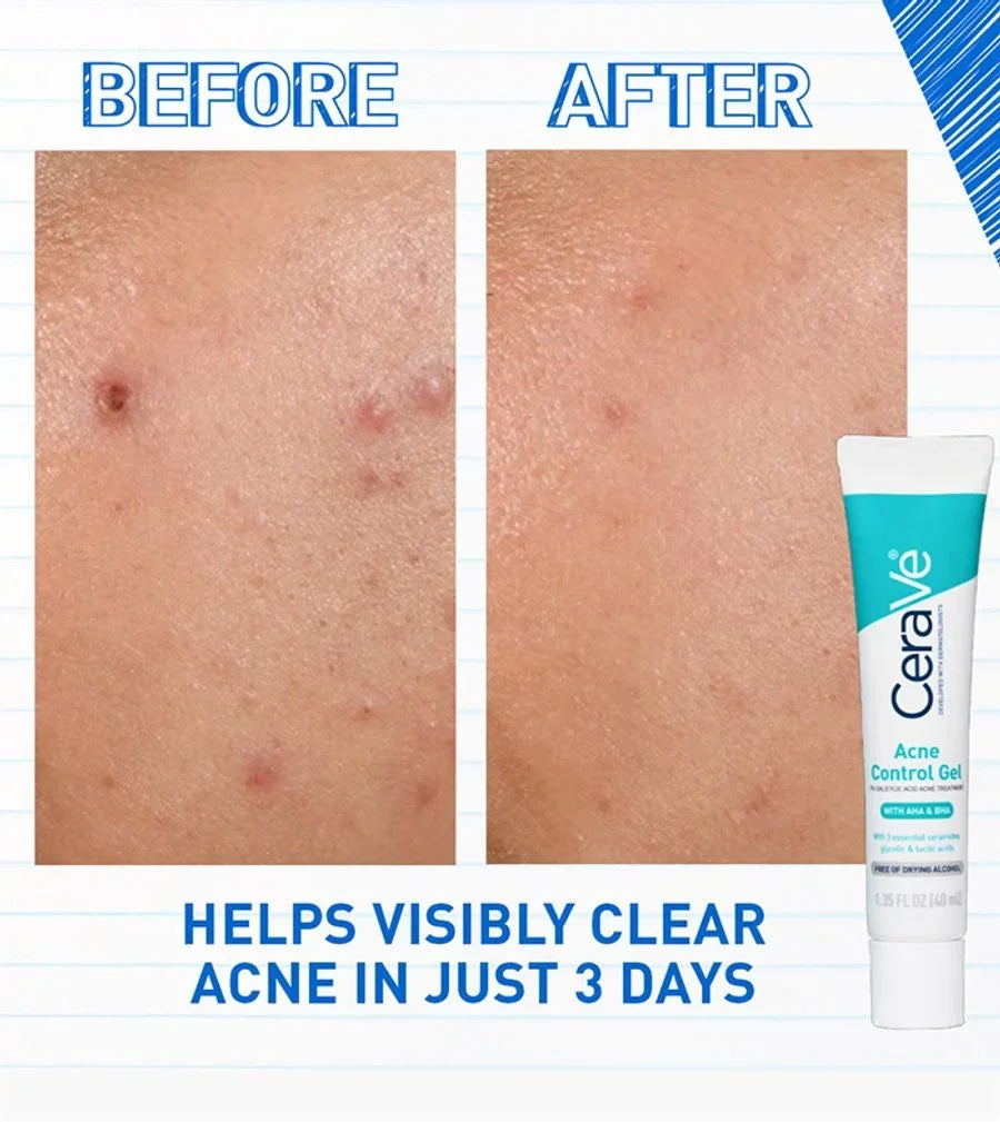 Acne Control Gel